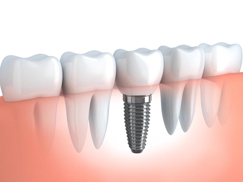 Dental Implants  Bountiful, UT 